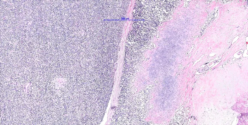 <p>Tumeur de la mandibule</p><p>1) Diagnostic</p><p>2) Localisation</p><p>3) Histologie</p><p>4) IHC</p><p>5) Moléculaire </p>