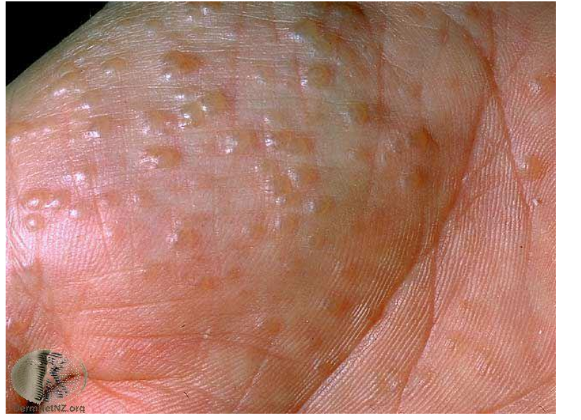 <ul><li><p><strong>vesicle</strong></p></li><li><p><em>This patient has pompholyx eczema on the thenar eminence (palm)</em></p></li><li><p><em>monomorphic lesions </em></p></li></ul><p></p>