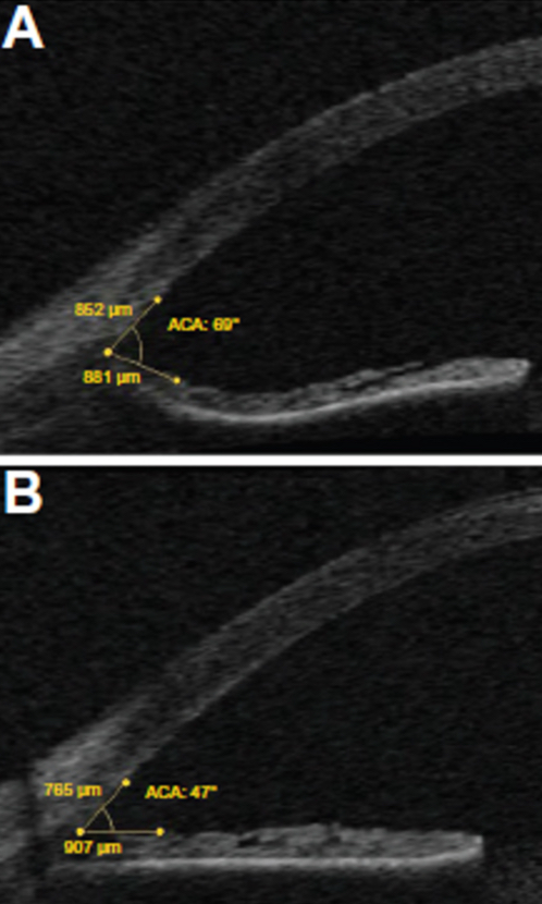 <p>Reduces the concavity of the iris</p>