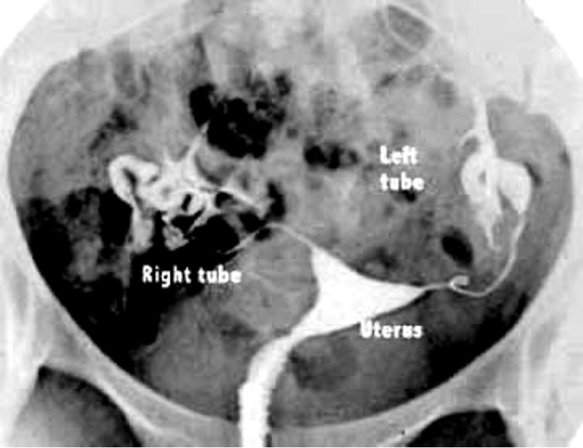 <p>evaluate patency of fallopian tubes </p>