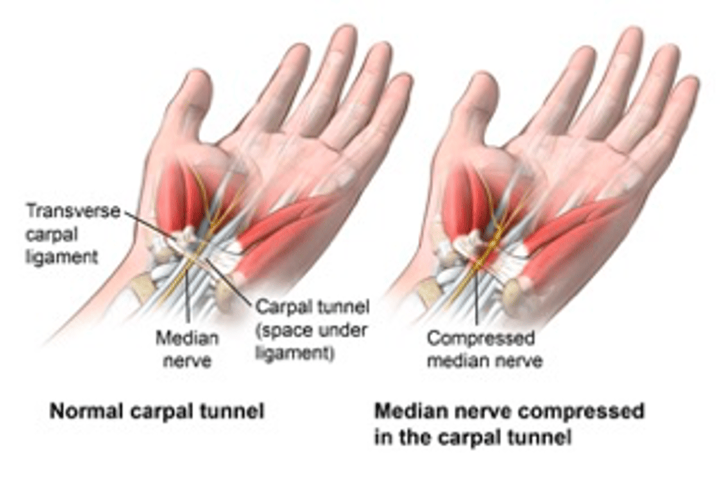 <p>•Numbness and tingling in the thumb, index finger, middle finger and radial aspect of the ring finger</p><p>•Sx worse at night w/ nocturnal awakening or when driving</p><p>•Patient reports needs to shake out the hand to get relief</p><p>•Weak grip or hand clumsiness</p>