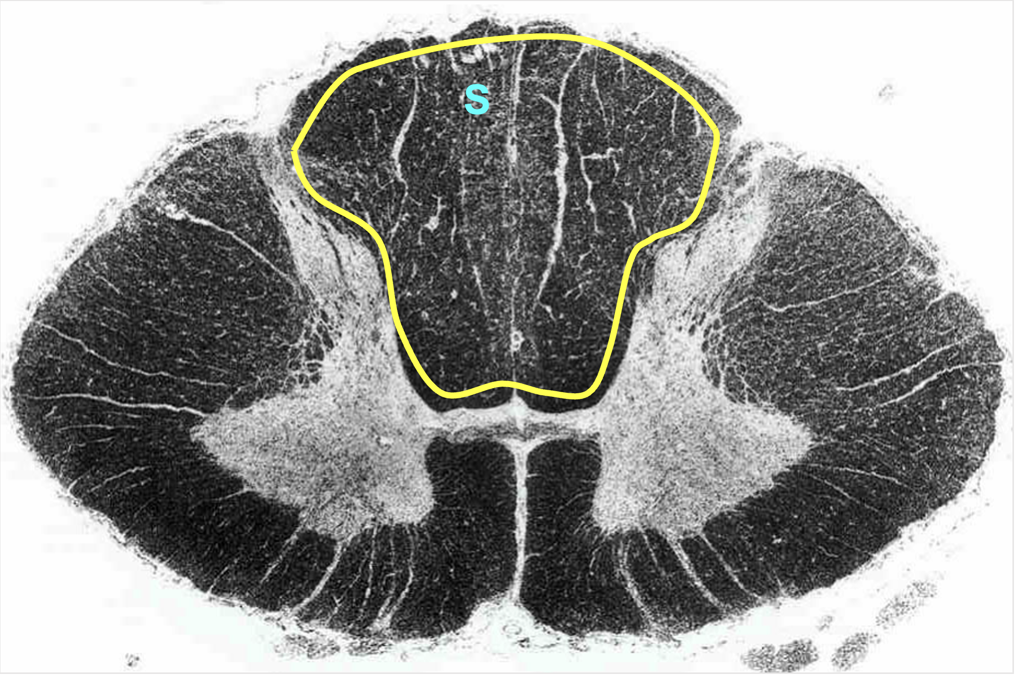 <p>white matter located in between dorsal horns; contain multiple tracts </p><ul><li><p>sensory information (ascending)</p></li><li><p>contains large diameter processes of dorsal root ganglia </p></li></ul><p></p>