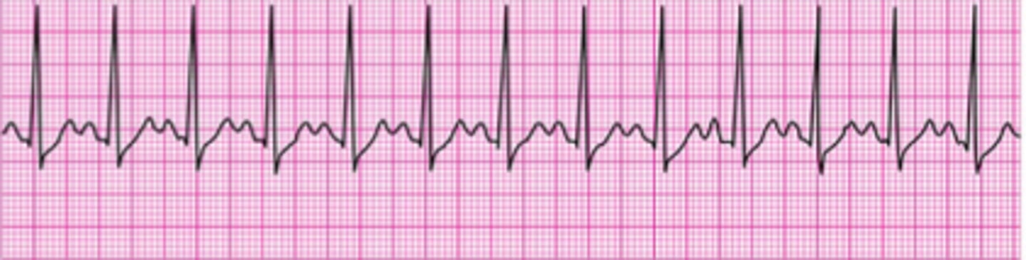 <p>- &gt;100 bpm</p><p>- Common causes: severe anemia, hyperthermia, hemorrhage, pain, fever, anxiety, sympathomimetic or parasympathetic Drug Administration.</p><p>- Treatment: treat underlying cause, hypoxemia = administer oxygen therapy.</p>