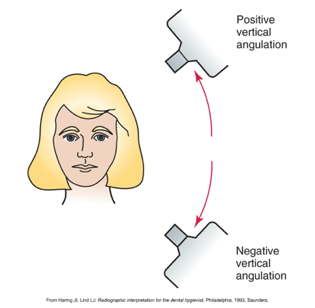 <p><span>-Positioning of PID in a vertical or up-and-down plane</span><br><span>Positive or negative</span><br><span>Degrees measured on outside of tubehead</span></p>