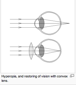 Hyperopia
