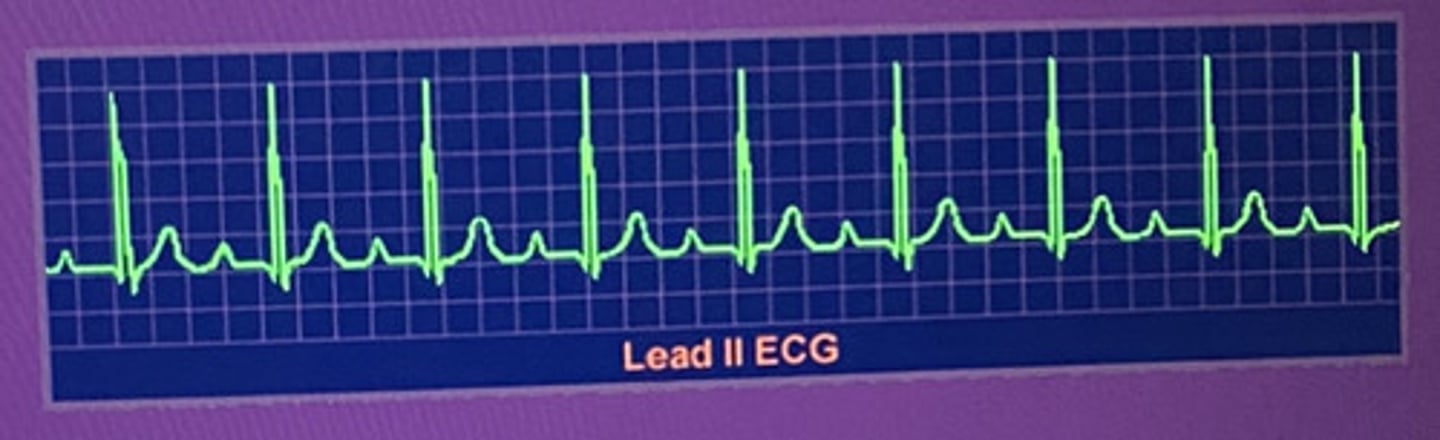 <p>What type of heart block is this?</p>
