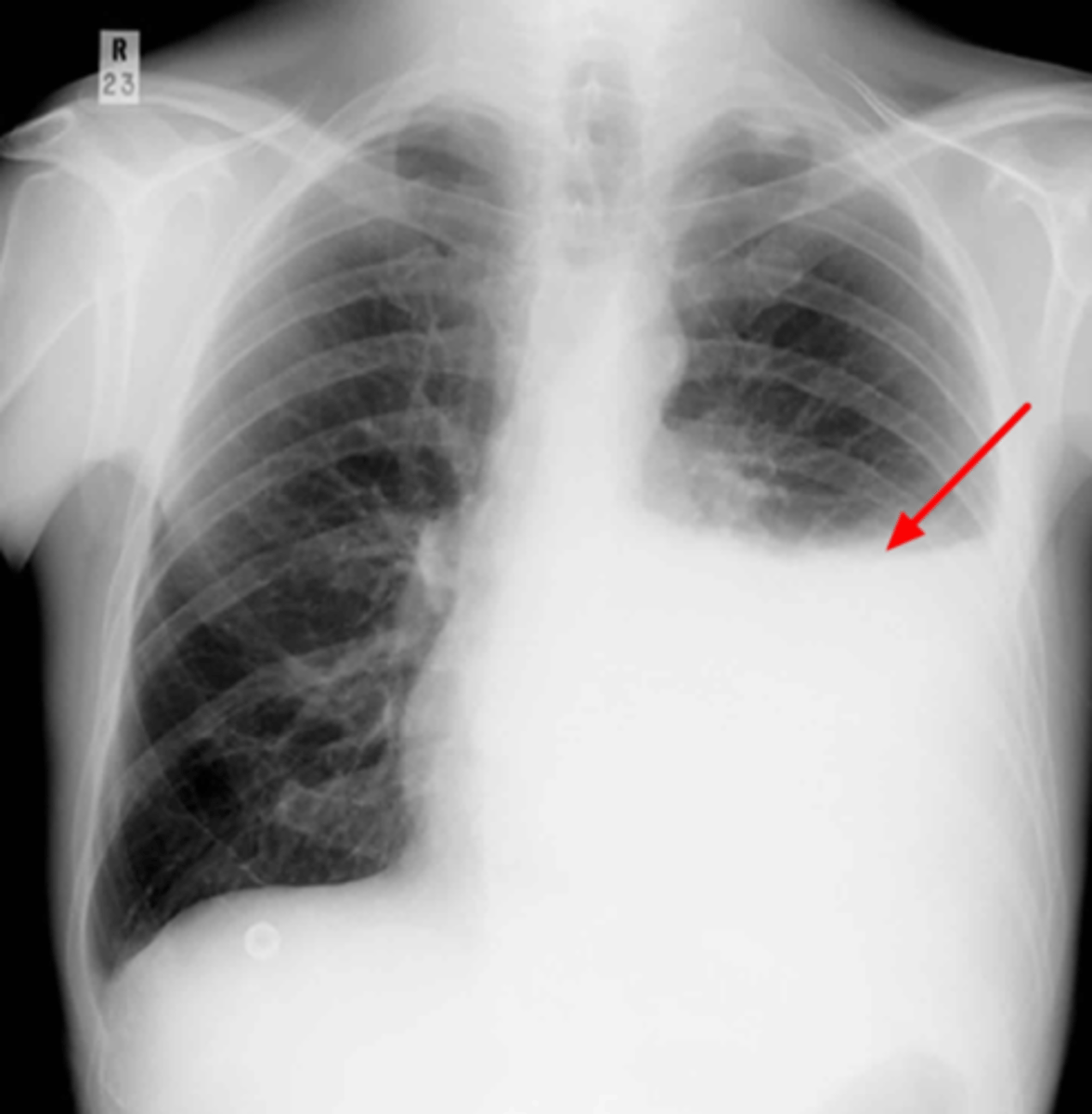 <p>fluid gathers in lowest part of chest according to patient's position Affected, region appears white throughout</p><p>Blunting of the costophrenic angles:</p>