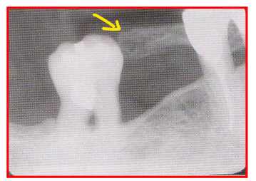 <ul><li><p>Client’s finger was incorrectly positioned in front of the film instead of behind the film so bony finger appears on the film. </p><ul><li><p>Reason: Finger-holding used in bisecting technique </p></li></ul></li><li><p>Fix: have client position finger behind film. </p></li></ul><p></p>