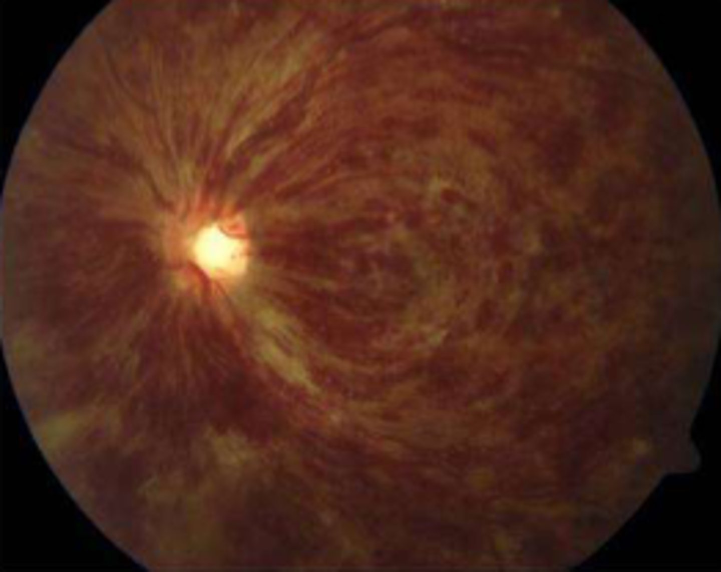 <p>CRVO is caused by a blockage of a vein that carries blood away from the retina, typically due to a clot or arteriosclerosis. It results in hemorrhage, leakage of fluid, and eventual edema.</p>