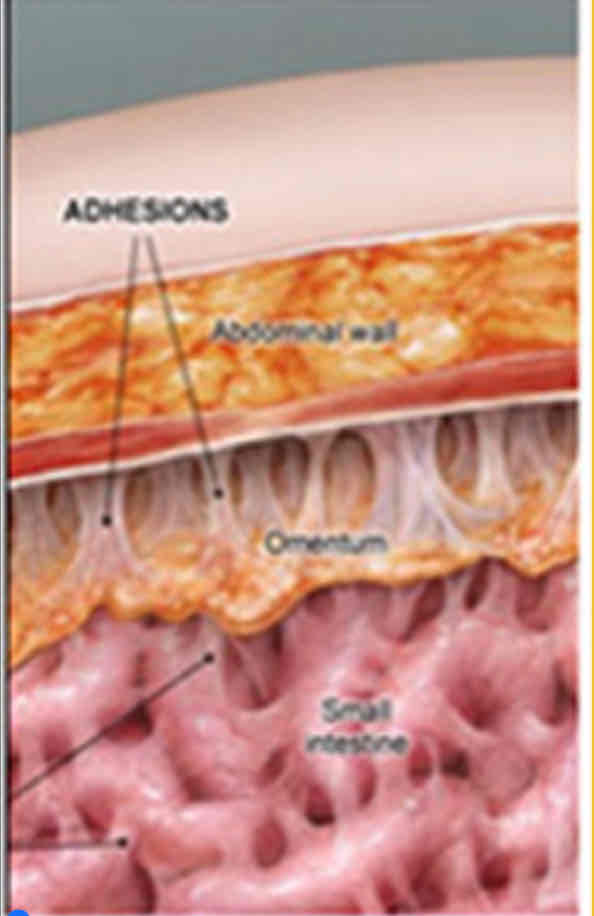 <p>Peritoneal Adhesions</p>