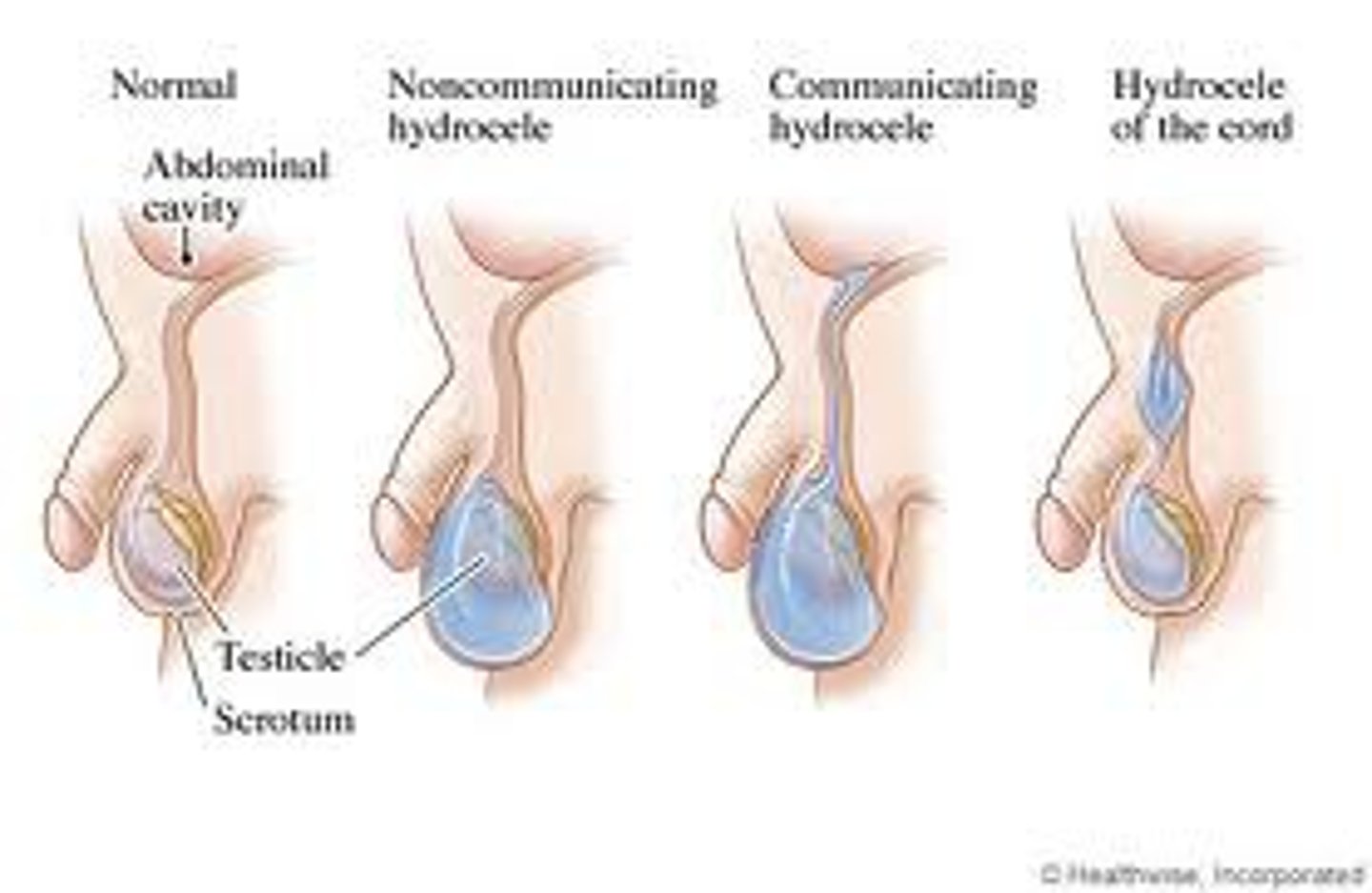 <p>a fluid-filled sac in the scrotum along the spermatic cord leading from the testicles</p>