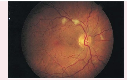 <p></p><ul><li><p>﻿﻿Also known as soft exudates, cotton wool patches have a fluffy cotton ball appearance, with irregular edges.</p></li><li><p>﻿﻿Appear as white or gray moderately-sized spots on retinal background</p></li><li><p>﻿﻿Caused by arteriole microinfarction</p></li><li><p>﻿﻿Associated with diabetes mellitus and hypertension</p></li></ul>