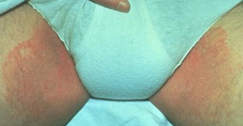 <ul><li><p><strong>Fungal Infection</strong>:</p><ul><li><p>Affects the groin.</p></li><li><p>Erythema, scaling, maceration in the inguinal creases or inner thighs (penis/scrotum spared).</p></li></ul></li></ul><p></p>