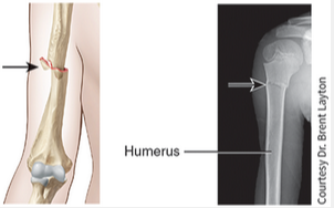 <p>One end of the fractured bone is forcefully driven into the interior of the other.</p>