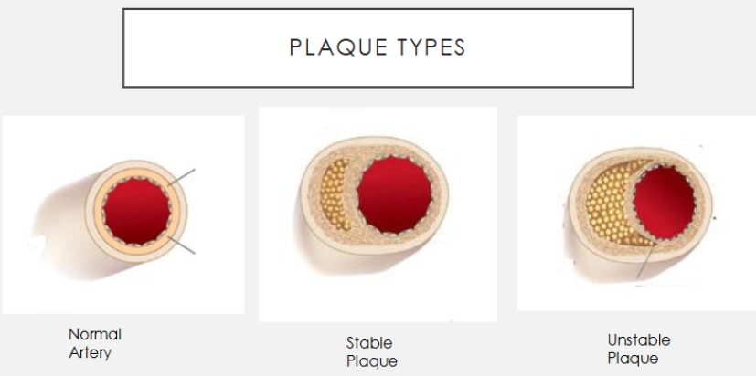 <p><strong><u>Acute Coronary Syndrome (ACS)</u></strong></p><p>Classified by <em>causative </em>event → total of 5 diff types </p><ol><li><p>Most common ~90% →</p></li><li><p>Arterial occlusion primarily driven by _____________ → MI</p></li><li><p>VTE driven by ________</p></li><li><p>Post MI pathophysiology → activates ____ and ______ </p></li><li><p>^ can create ________ leading to HF</p></li></ol><p></p>