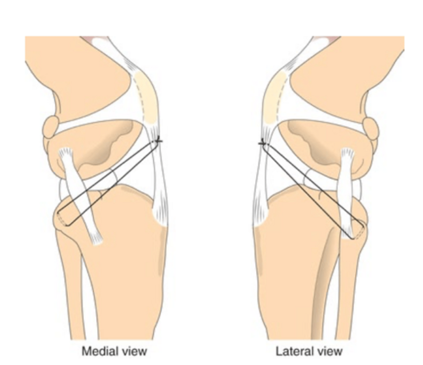 <p>what technique is used to sx. repair CaCL rupture</p>