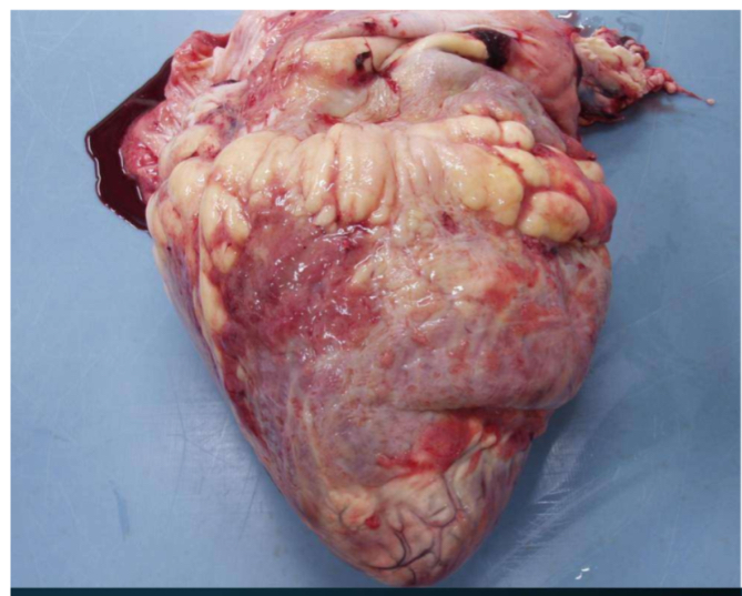 <ol><li><p>Ruminant heart- can tell from fat on surface (difficult question)</p></li><li><p><strong>Description in 3 words- </strong>white, fibrinous, pink</p></li><li><p><strong>Potential diagnosis-</strong> pericarditis</p><ol><li><p>Simple pericarditis</p><ol><li><p>Fibrous constrictions across pericardial sac</p></li><li><p>Patchy white adhesions btwn layers of pericardium</p></li><li><p>Mild lesion of no apparent clinical</p></li><li><p>Cause not determined at slaughter</p></li><li><p><strong>Judgement- category 2, local rejection</strong></p><ol><li><p>Because of possible bacteria</p></li></ol></li></ol></li><li><p>Suppurative pericarditis</p><ol><li><p>Complications of traumatic reticulitis with wire extending infection into pericardial sac</p></li><li><p>Pericardial sac contains foul smelling and pure lent or serofibrinous exudate</p></li><li><p><strong>Judgement- category 2, total rejection</strong></p><ol><li><p>Because of possible bacteria</p></li></ol></li></ol></li></ol></li><li><p><strong>Judgement- </strong>category 2, local rejection</p></li></ol><p></p>