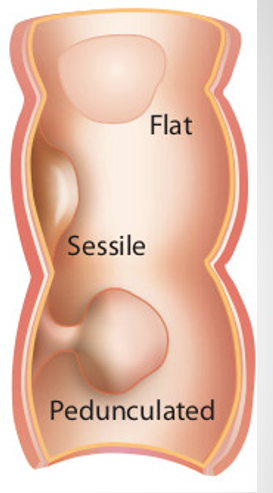 <p>irregularly shaped, low reflective structures that may be sessile (attached at base) or pedunculated&nbsp;</p>