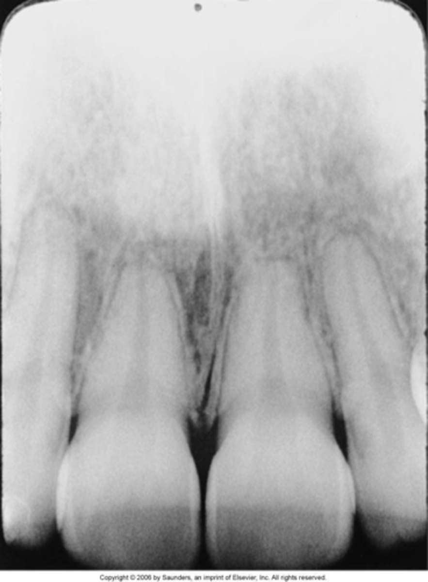 <p>teeth appear short with blunted roots</p><p>caused by too steep vertical angulation</p>