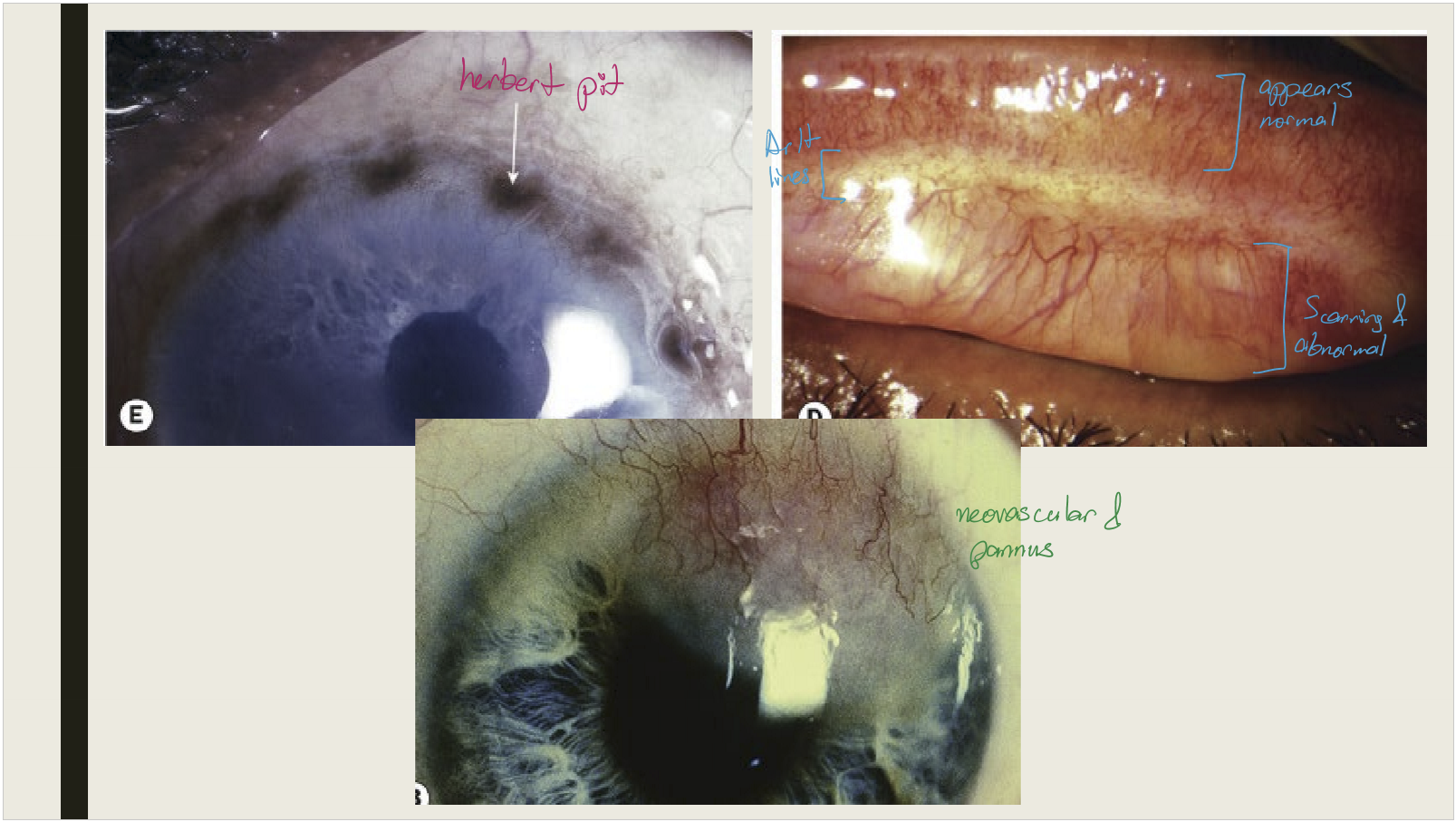 <p>Conjunctival scarring </p><ul><li><p>Mild infection: linear or stellate scarring</p></li><li><p>Severe infection: broad confluent scared (Arlt lines)&nbsp;</p></li><li><p>Superior tarsal effected more then other areas of conjunctiva&nbsp;</p></li></ul><p></p>