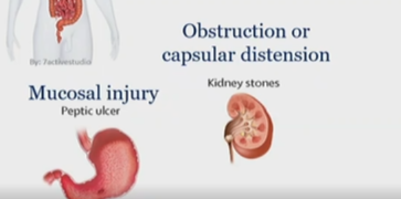 <p>kidney stone</p><p>visceral pain, nociceptive</p>