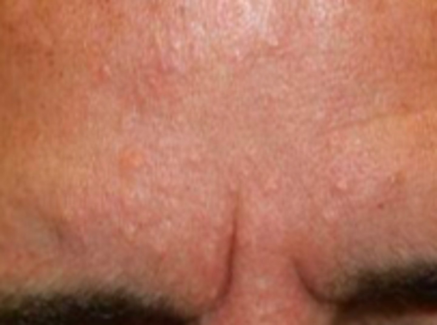 <p>Acneiform Disorders:</p><p>Subjective:</p><p>- Cosmetic</p><p>- pt wonder: Possible malignancy?</p><p>- Lesions are:</p><p>Asymptomatic, soft, discrete, and yellow; surface that can be smooth or slightly verrucous</p><p>1 or multiple lesions at various locations on face</p><p>Become red/irritated/bleed after scratching, shaving, other trauma</p>
