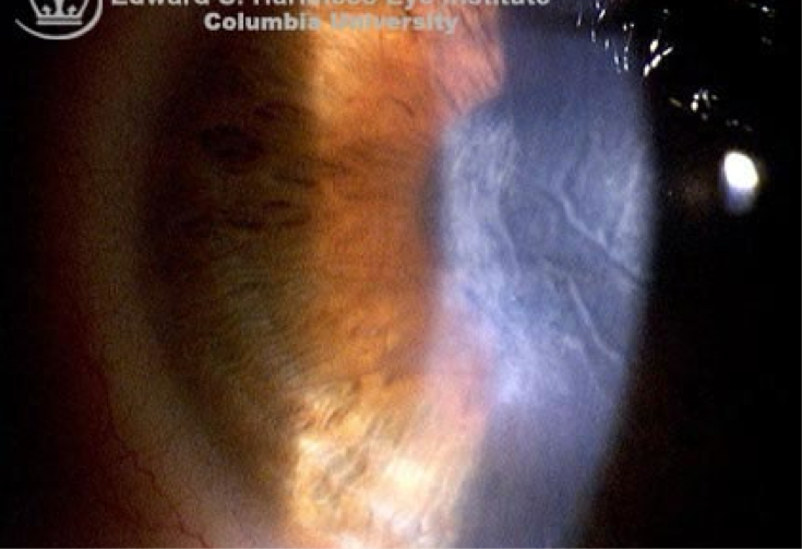 <ul><li><p>dark, deep-appearing, criss-cross lines in <em>posterior</em> stroma</p></li><li><p>cornea can appear hazy d/t corneal edema</p></li><li><p>commonly seen after <em>surgery</em></p></li></ul><p></p>
