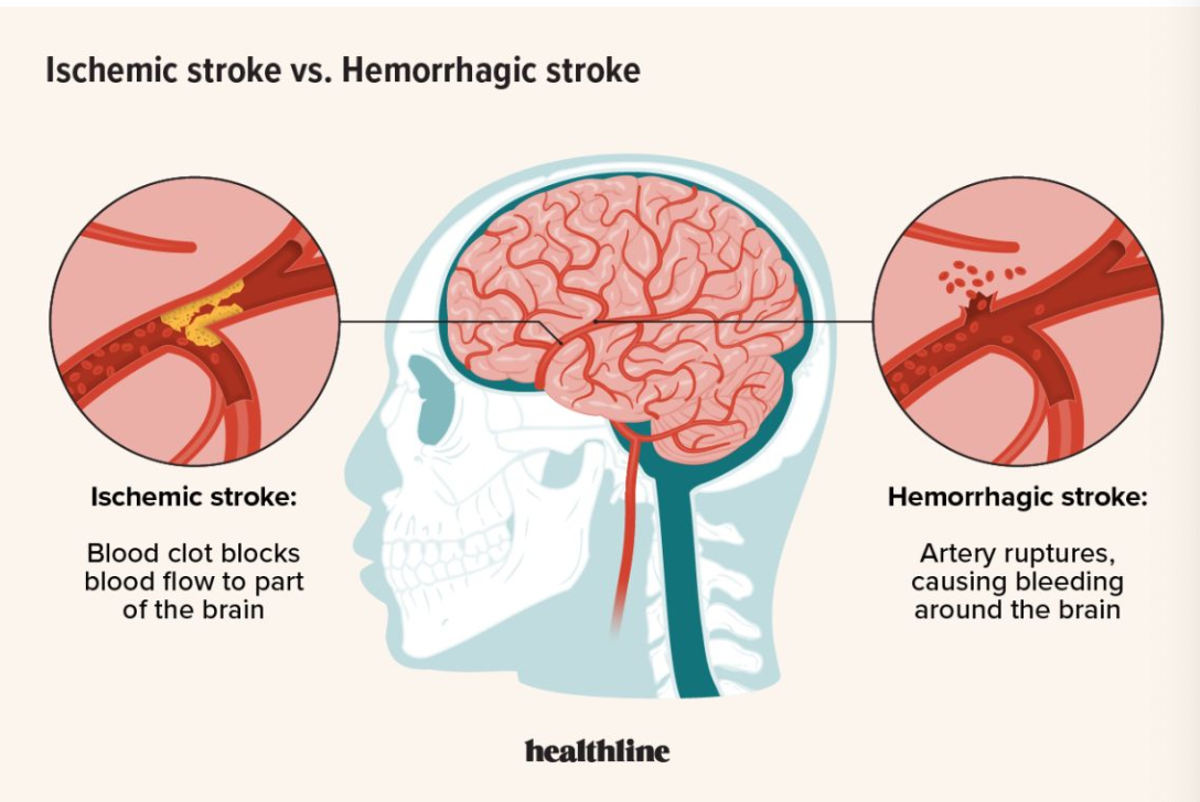 <p>Ischemic Stroke </p>