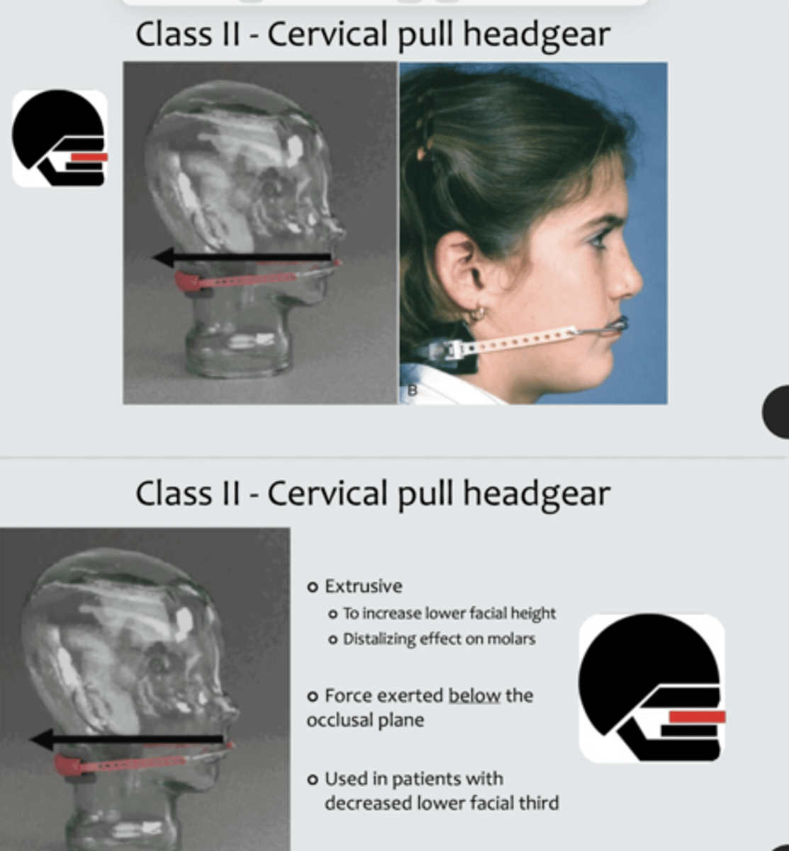 <p>Class II</p><p>Removable</p><p>Functional</p>