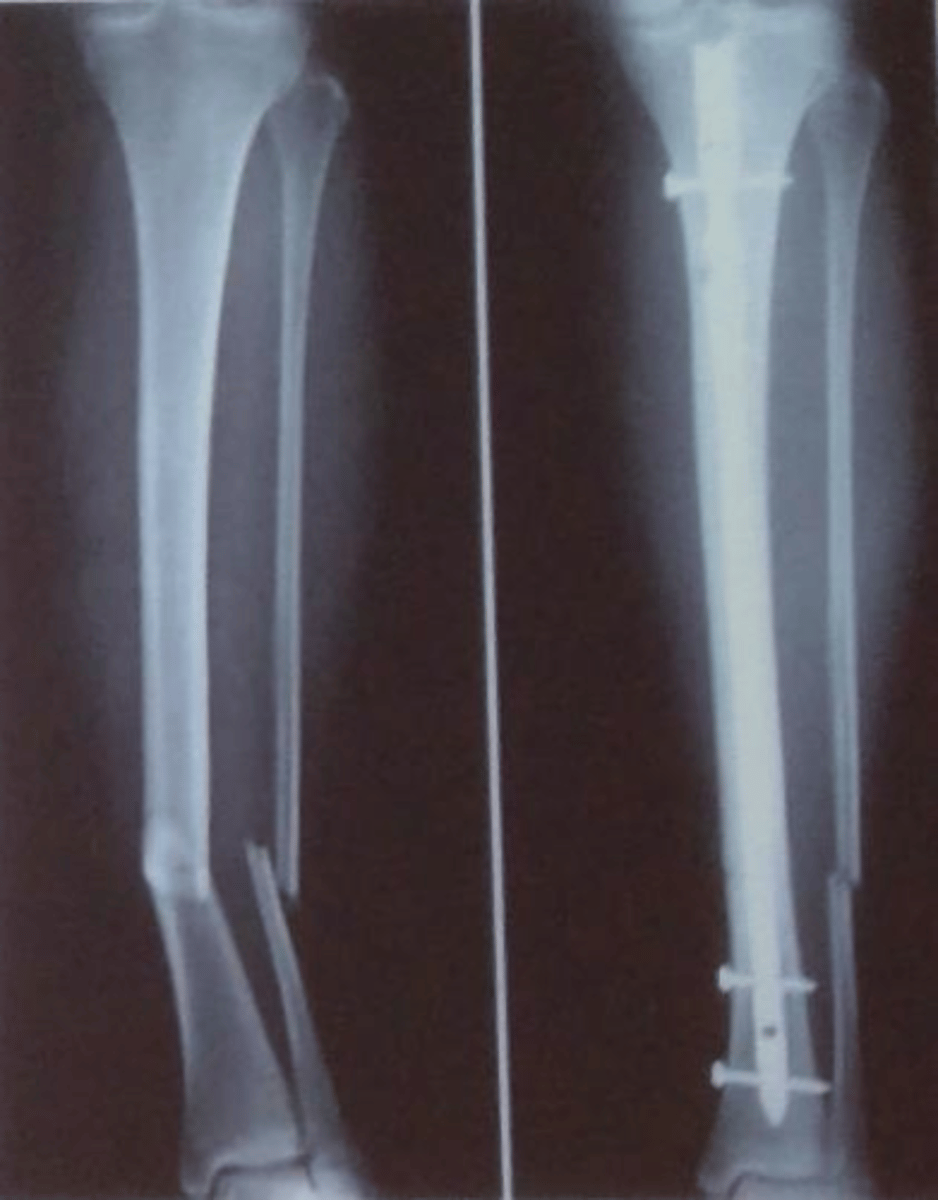 <p>through both tib and fib</p>