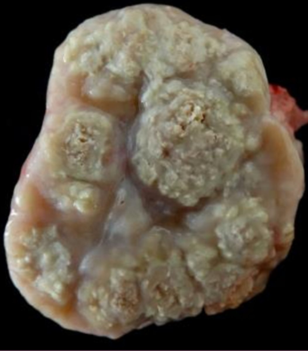 <p>describe what extracellular inclusion you would expect to see with this lesion</p>