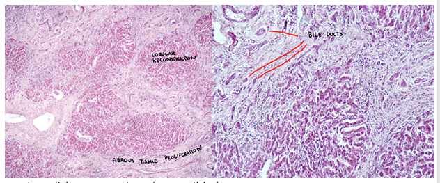 <p><strong>Cirrhosis hepatis </strong>(hepatitis interstitialis chronica)</p>