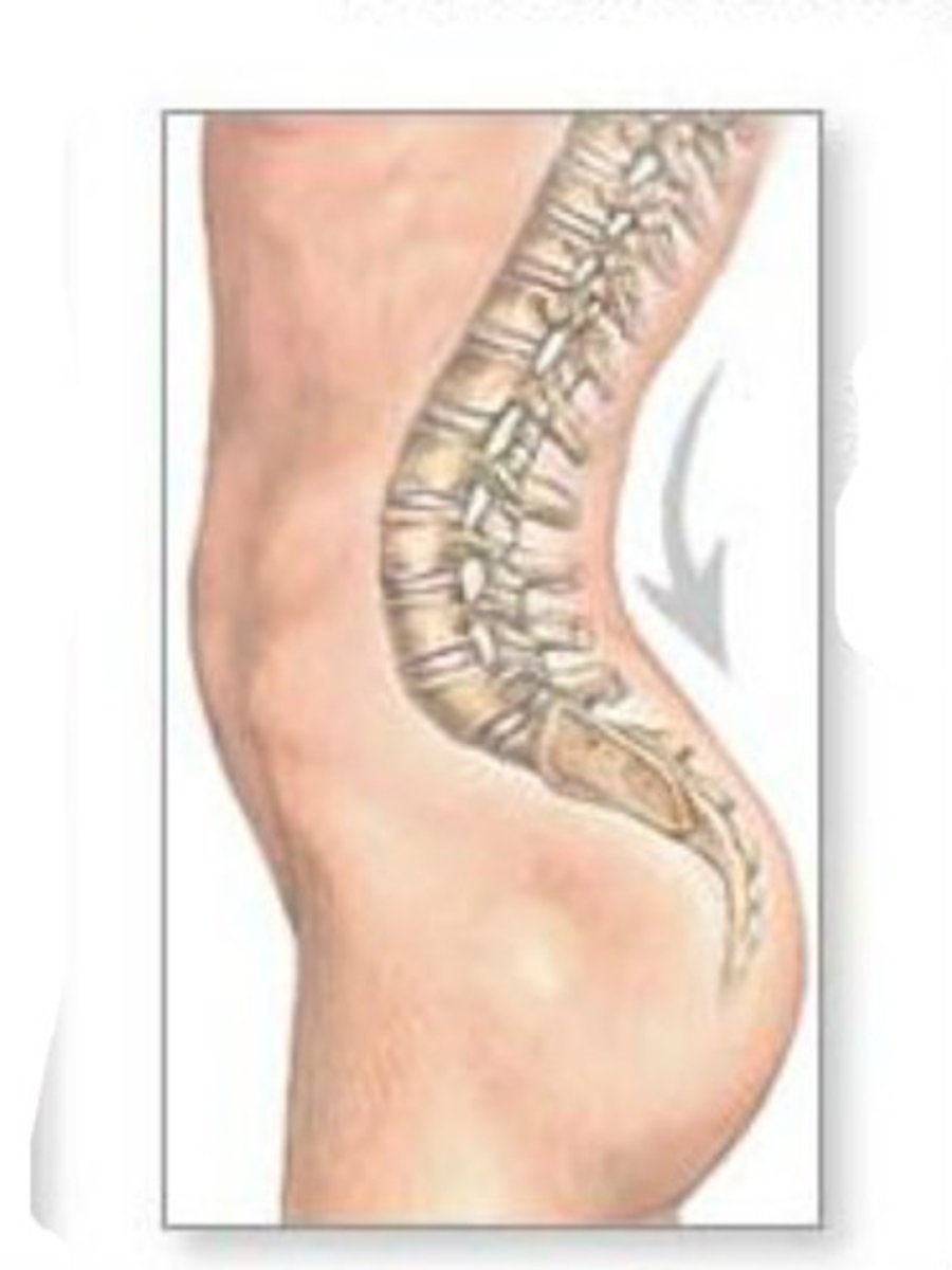 <p>abnormal curvature of the spine in which the lower back is more pronounced than the upper back (also called "swayback")</p>