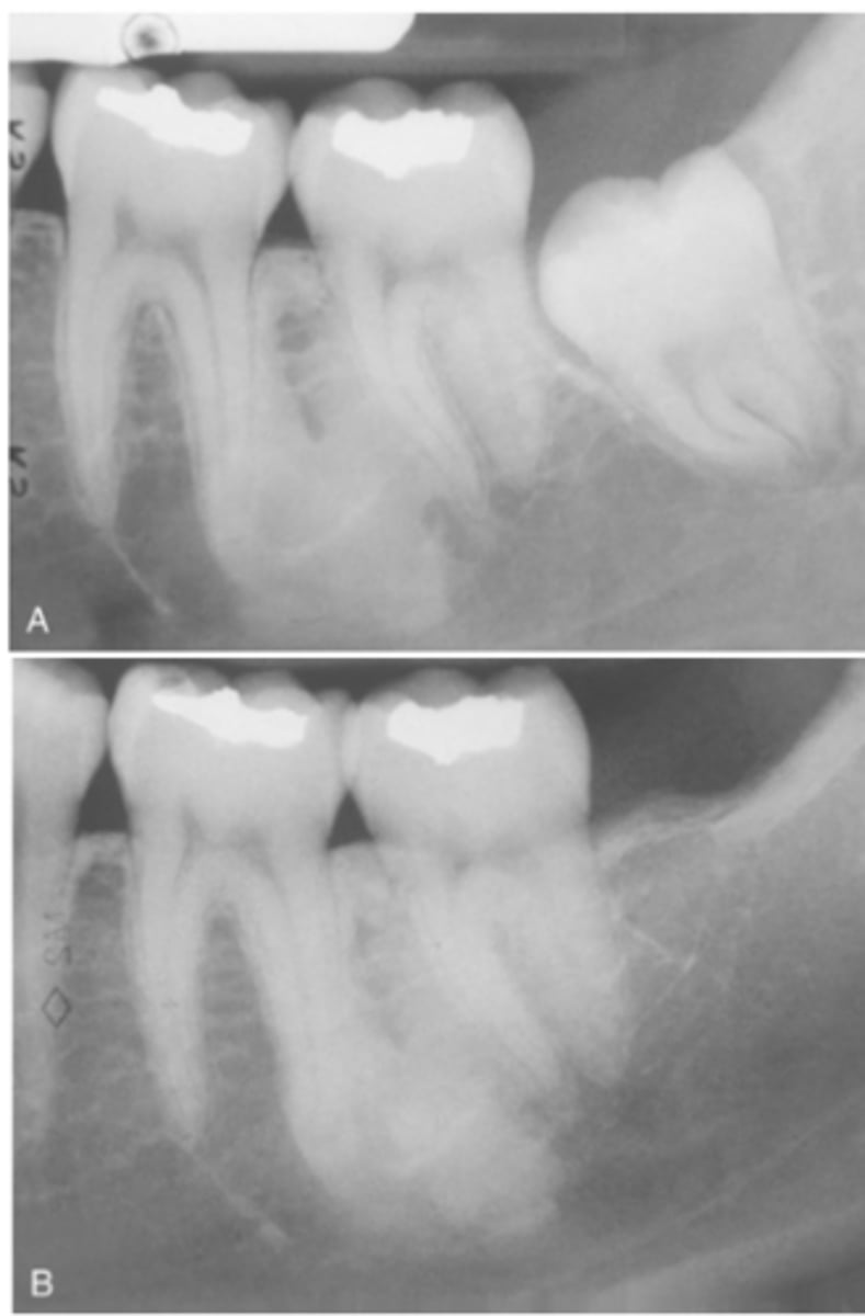 <p>How is Idiopathic Osteosclerosis typically detected?</p>