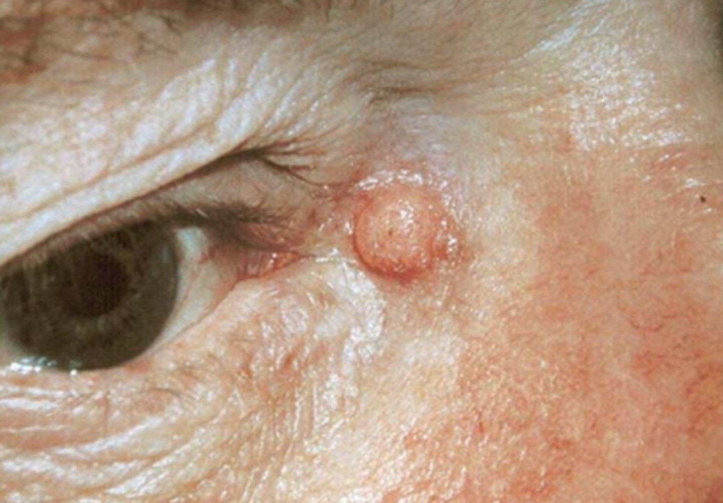 <p>A = asymmetry = benign lesions tend to be more symmetric</p><p>B = borders of the lesion = benign lesion tend to have regular borders</p><p>C = colour = changes in color, inconsistent color can be concern for malignancy</p><p>D = diameter = larger lesions (> 5mm) give concern for malignancy</p><p>E = evolution or elevation = how has it changed in color, bleeding, crusting, change in tissue composition, etc.</p>