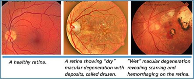 <p>acute or chronic deterioration of central vision characterized by drusen and no pain or redness</p>