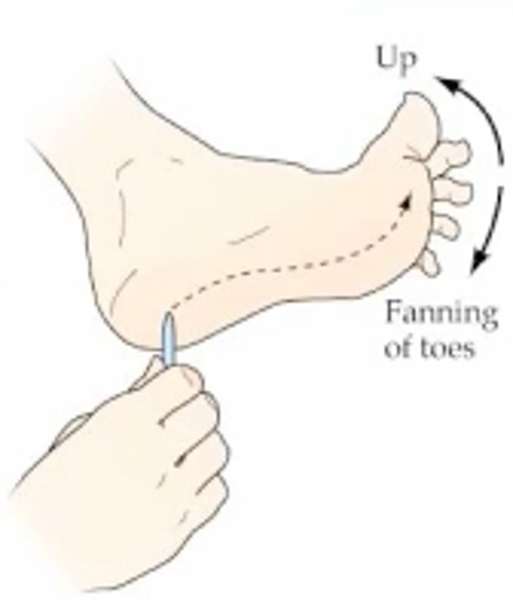 <p>firm stroke along lateral border of sole, big toe extends and others fan out</p><p>- should integrate within 2 years</p><p>- abnormal after age 2</p>