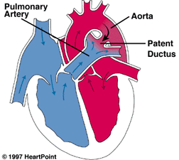 <p>patent ductus arteriosus </p><ul><li><p>it connects the main pulmonary artery to the proximal descending aorta in a fetus </p></li></ul><p></p>