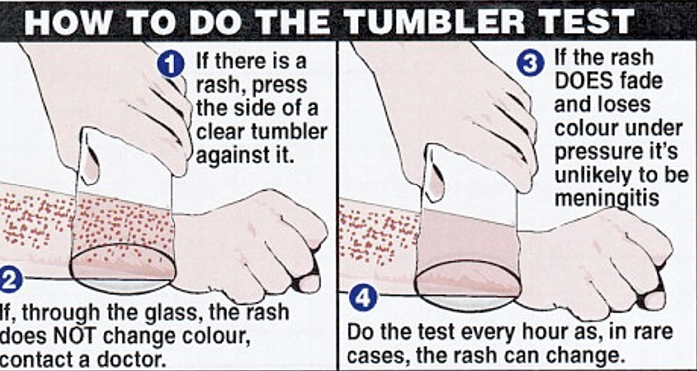 <p>If rash does not change colors then medical referral should be given.</p>