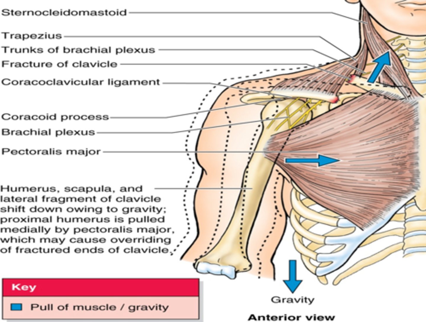 <p>The inflection point. It is the weakest point of the clavicle, more prone to fractures</p>