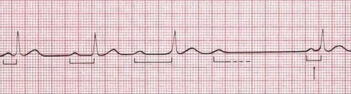 A disease process when there is a progressive prolongation of the PRI culminating in a non-conducted p Wave missing a QRS Complex. The PRI longest immediately before the dropped QRS