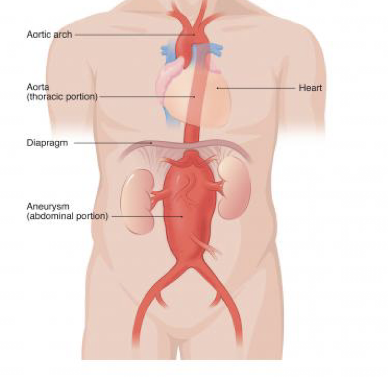 <p><strong>focal dilation of all layers of aorta, </strong>most commonly <strong>below renal arteries</strong></p><p><em>Risk Factors: </em>AMAB, &gt;65yo, family history, <span style="color: red"><strong>smoking</strong></span><strong>, </strong>hypertension, CAD, DM, obesity, chronic alcohol use</p><p>S/S: <strong>back or abdominal pain,</strong> lower extremity weakness, radicular pain, GI hemorrhage, <strong>tachycardia</strong> if pain/hemorrhage, <span style="color: red"><strong>hypotension suggests rupture</strong> </span><br>PE: abdominal palpation, neurologic exam</p><p>Dx: CT or US, <strong>CBC, CMP, Coags, </strong>Urinalysis</p><p>Tx: <span style="color: red"><em>Rupture</em></span>: <span style="color: red"><strong>immediate</strong> <strong>surgical</strong> <strong>repair</strong></span>, pain control, blood pressure (permit hypotension, beta blockers for hypertension, rate control)</p><p><em>Symptomatic</em><strong>: repair recommended (</strong>esp. <strong>&gt;5cm), </strong>admit to critical care/treat as ruptured if unstable</p>