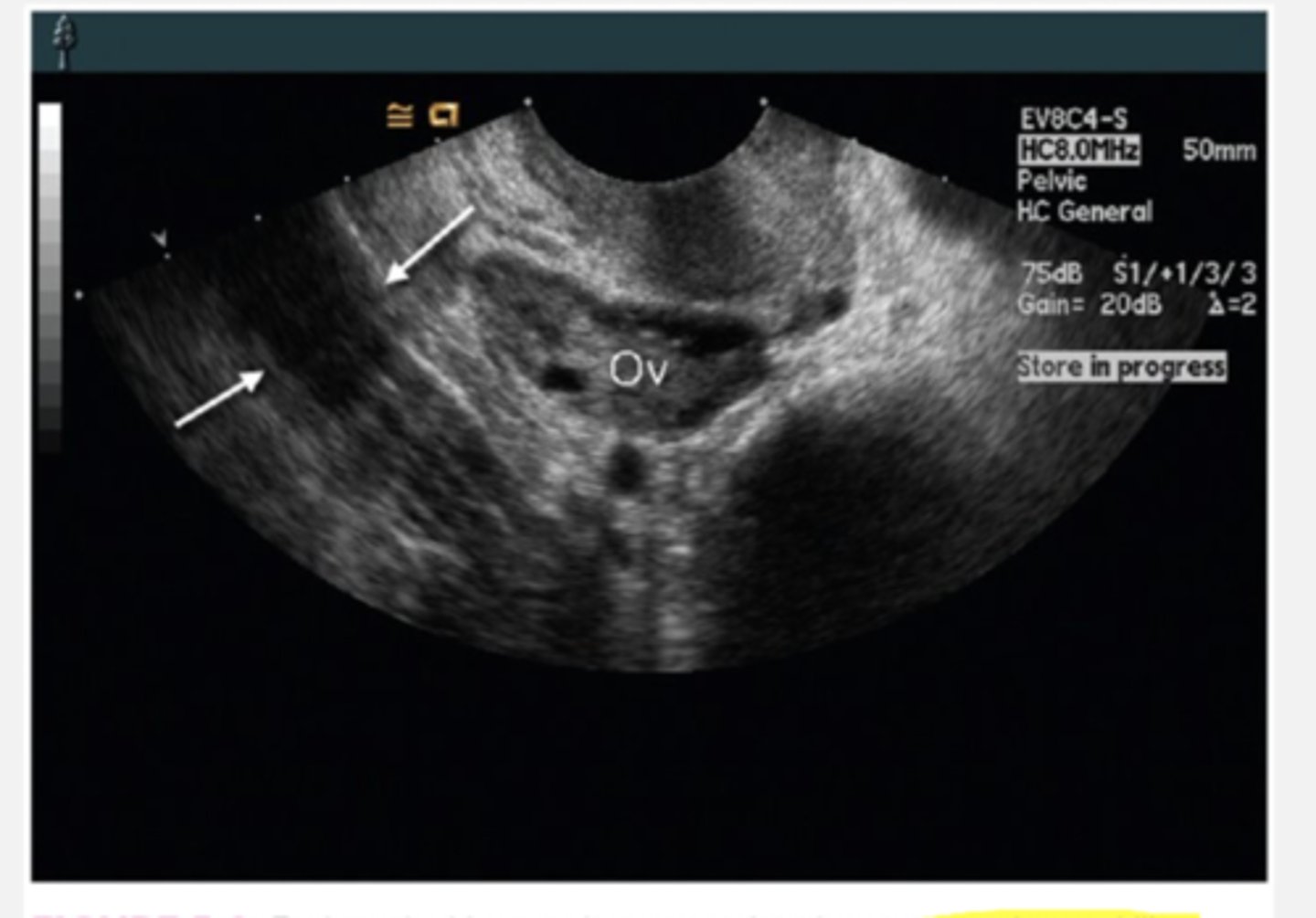 <p>an adnexal mass. make sure to elongate.</p>