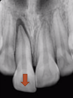 <p>tooth travels incisally out of socket, or partially</p><ul><li><p>avulsion → tooth completely leaves socket</p></li><li><p>can mimic appearance of a periapical lesion, but crown appears supererupted</p></li><li><p>questionable prognosis → depends on how soon tooth is repositioned into socket</p></li></ul><p></p>