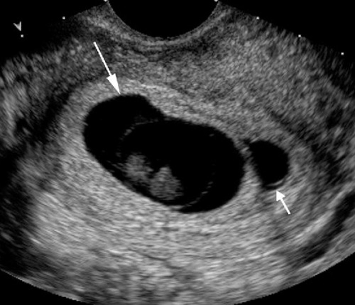 <p>Early twinning with a demise of 1 twin</p><p>Demised twin is reabsorbed</p>