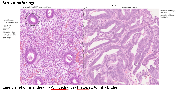 <p>Atypiska celler med abnorm proliferation, invasion och spridningspotential; blir cancer vid strukturell störning och ibland invasion</p>