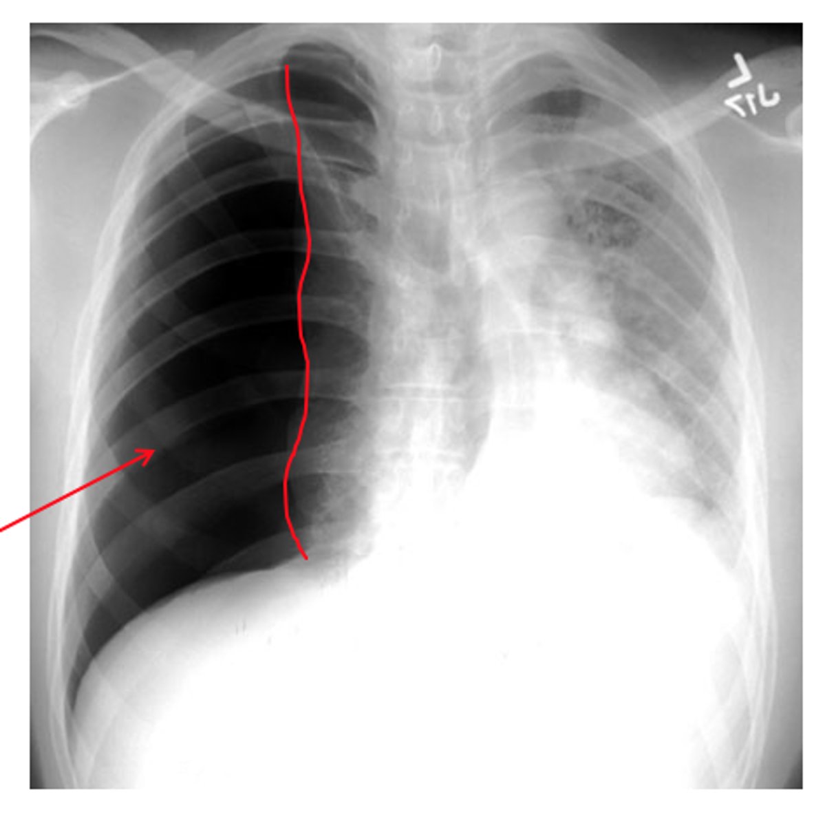 <p>b. pneumothorax.</p>