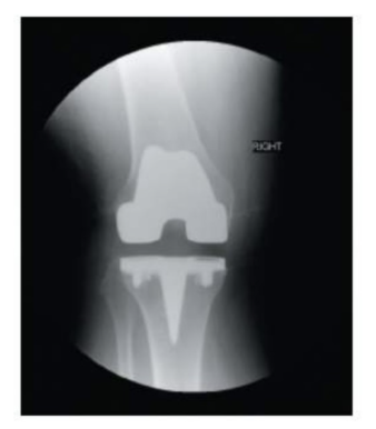 <p>The x-ray of the right knee above shows a total knee replacemnet with prosthesis implant. What view is this presentation?</p>