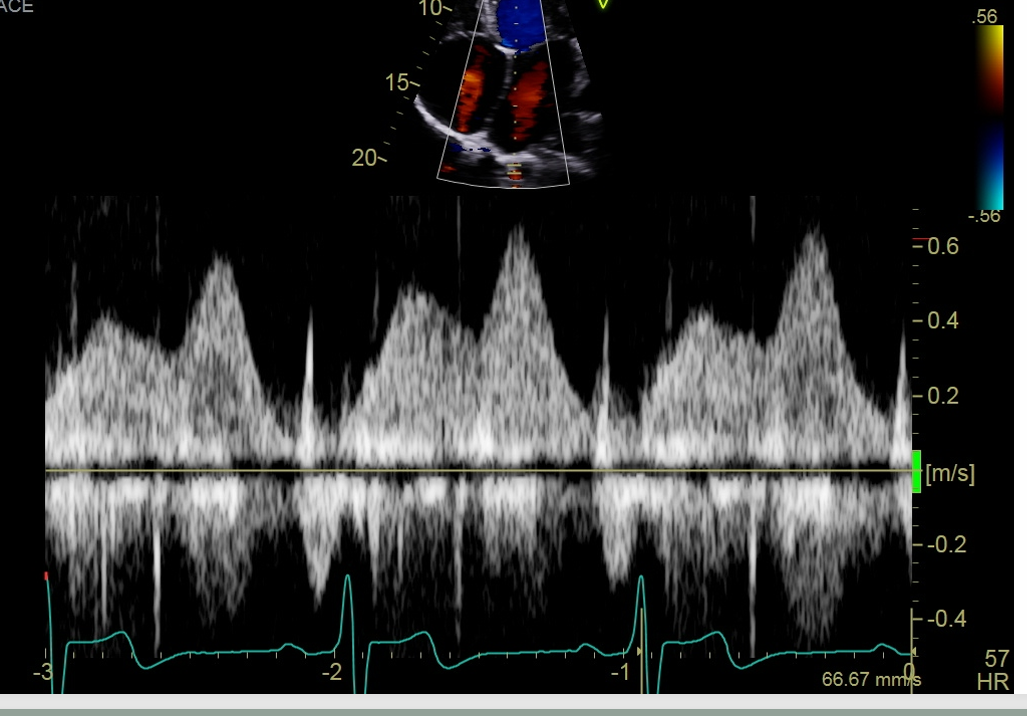 <p>Obtain PW of pulmonary veins</p>