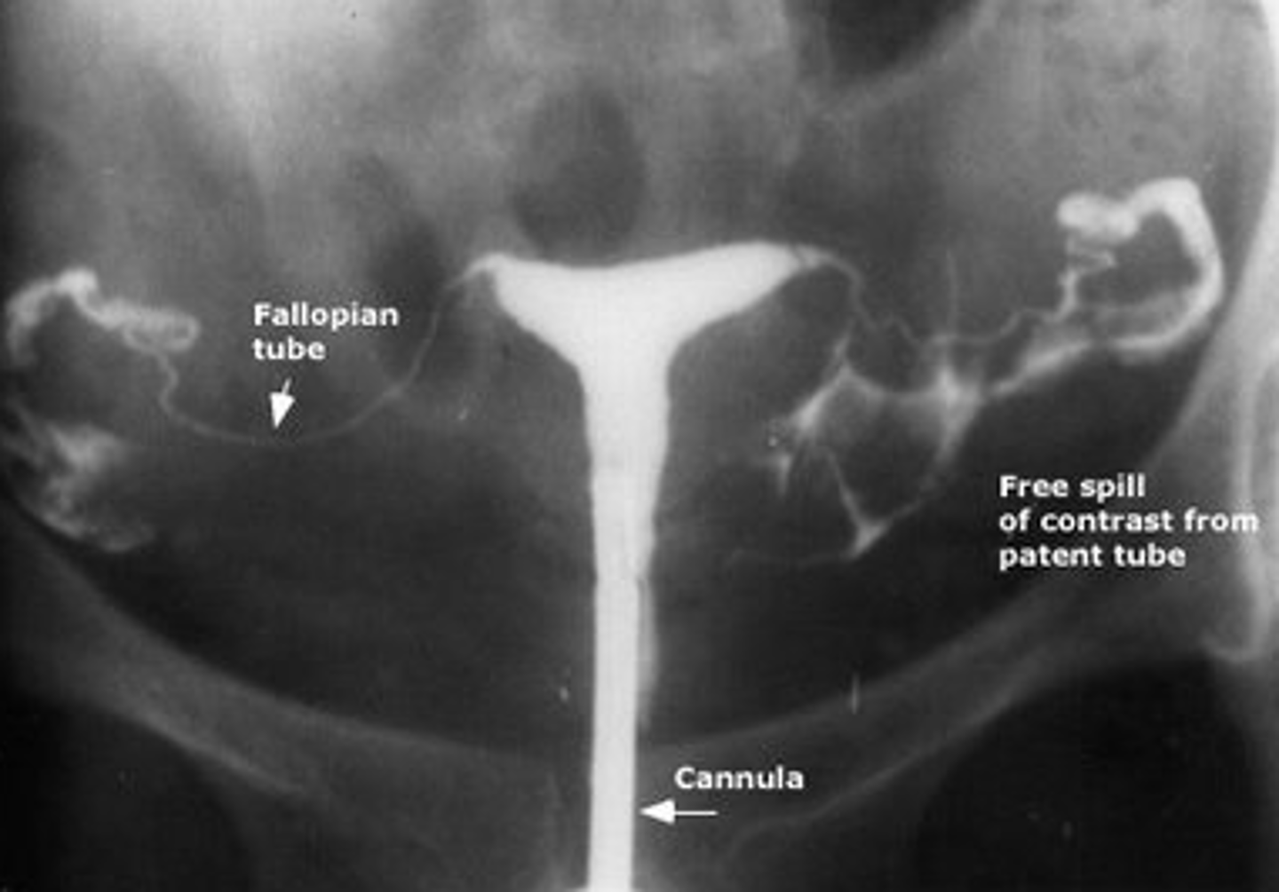 <p>process of recording the uterus and fallopian tubes</p>